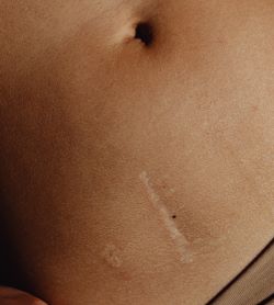 복부흉터