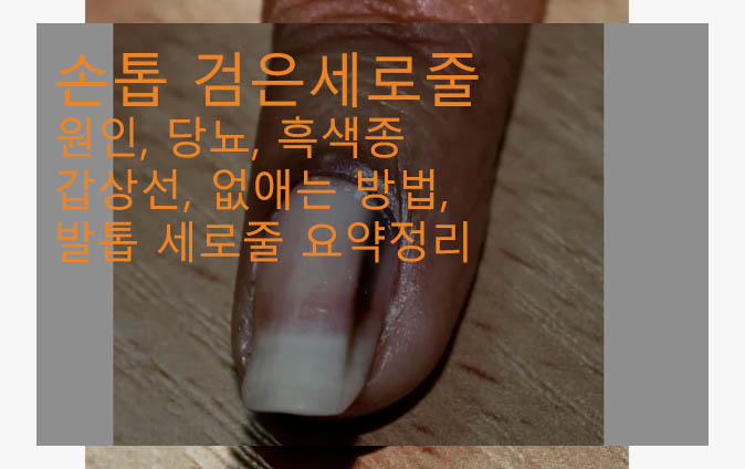 손톱 검은세로줄 원인, 당뇨, 흑색종, 갑상선, 없애는 방법, 발톱 세로줄 요약정리