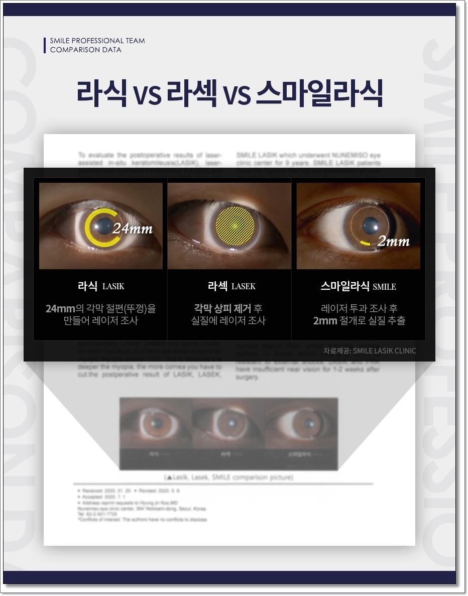 라섹회복기간 1일 8
