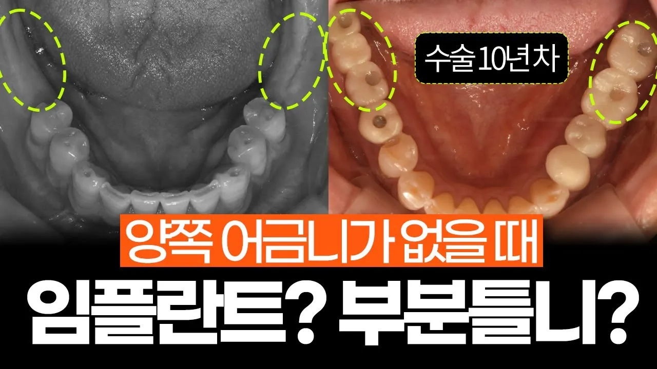 어금니 칫솔 사용법 선택방법 실사용 후기_1
