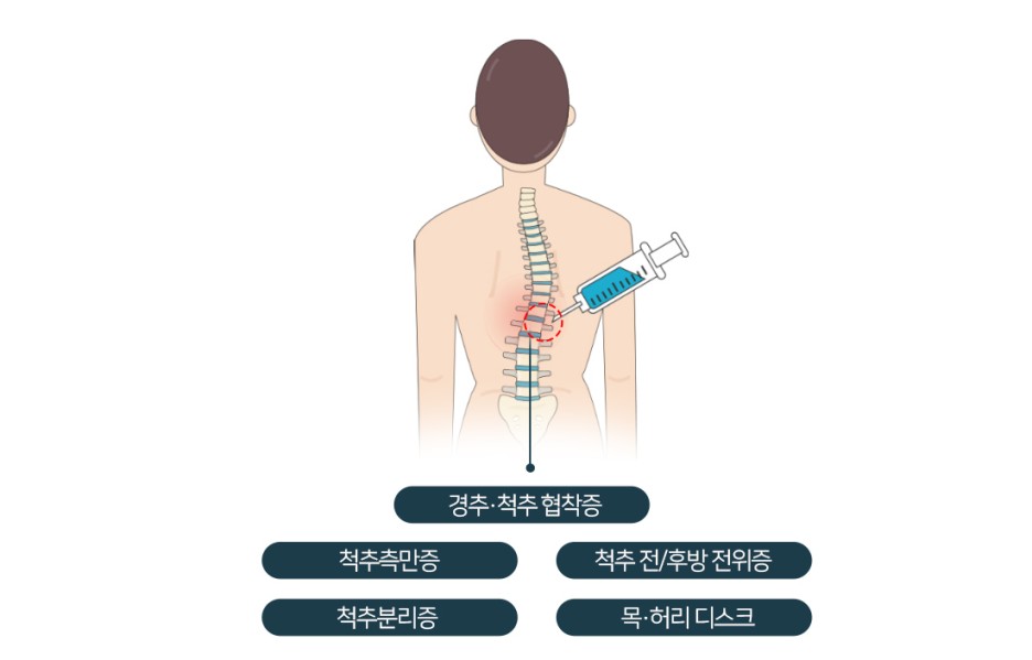 [프로필 치료/프로필러 주사] 프롤린 주사 부작용은? 19