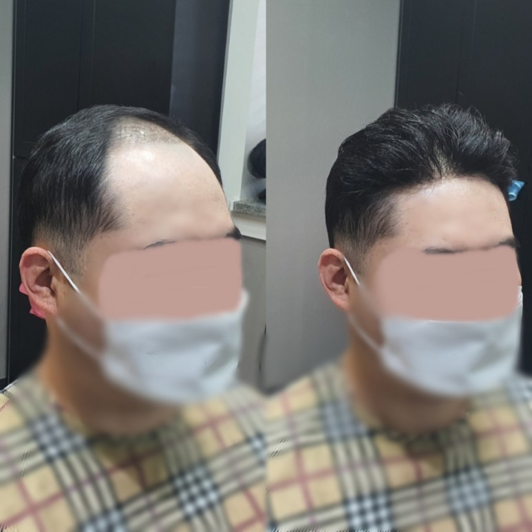 부분가발  여기 있었네