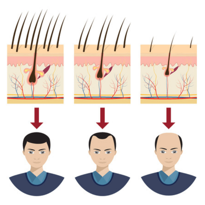 중년-남성-탈모-진행-과정