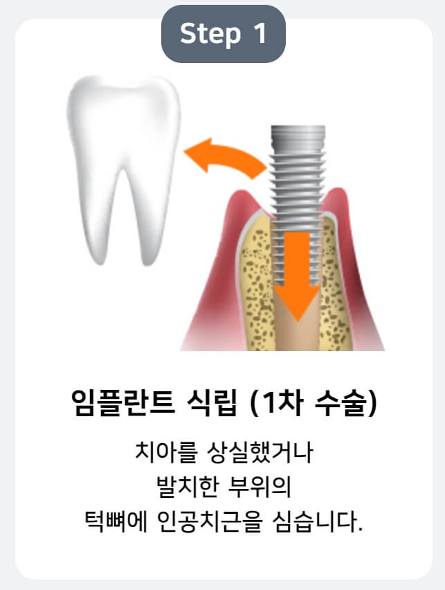 임플란트-식립-사진