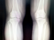 연골에 좋은 음식