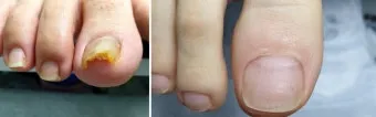 라셀턴 사용법과 가격 비교 발톱앰플 후기 정리해보기_11