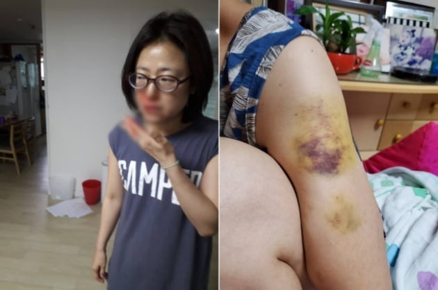 피투성이 황보승희…가정폭력 前남편의 피해자
