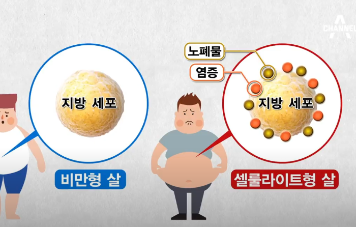 튼살 &amp; 셀룰라이트, 이젠 안녕! 흔적 지우개 솔루션 (feat. 예방 &amp; 개선, 추천 제품, 마사지 &amp; 운동, 시술 정보, 관리 후기)