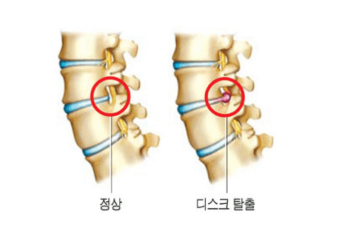 허리디스크-정상과-디스크탈출-모습-비교