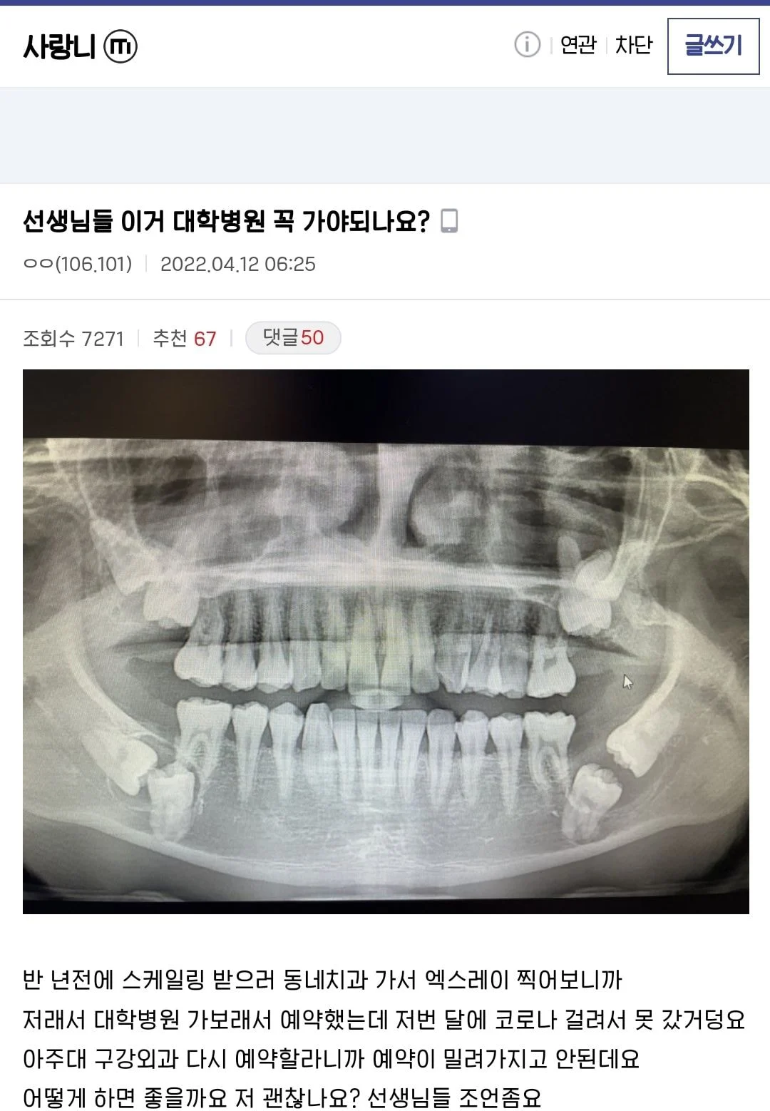  선생님들 이거 대학병원 꼭 가야되나요? (역대급 사랑니 수술후기)