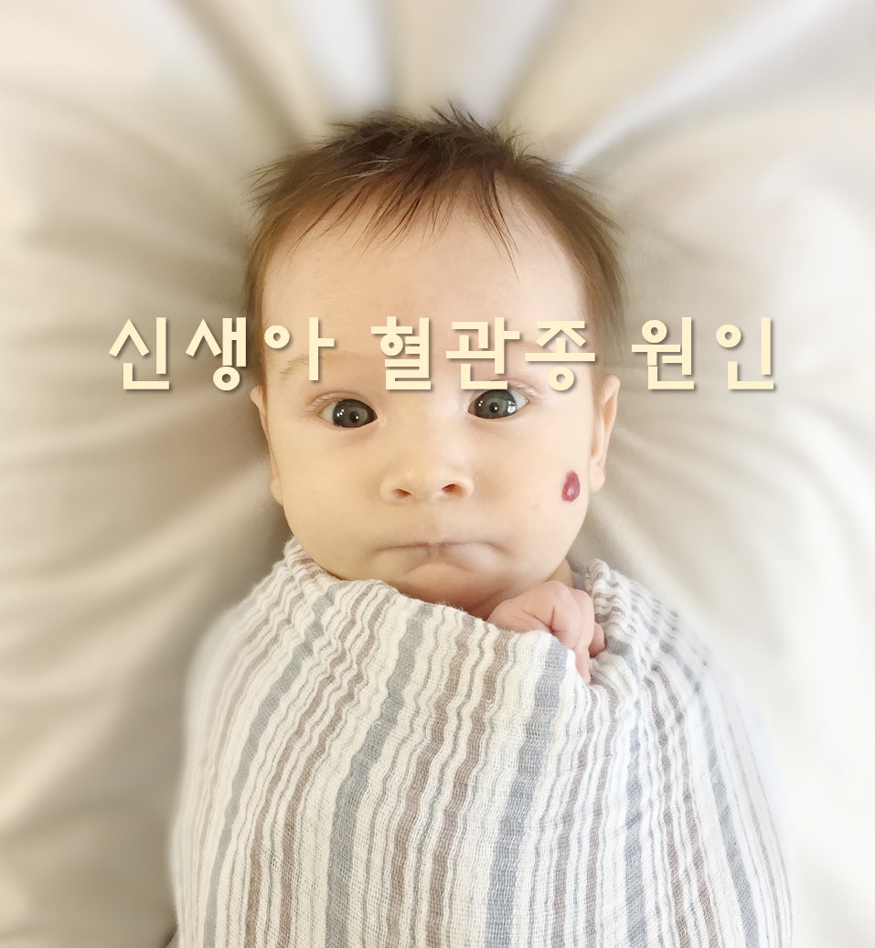  신생아 혈관종 원인과 치료 방법