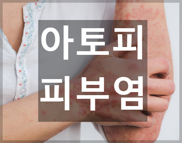  환절기에 더욱 관리가 필요한 아토피 피부염