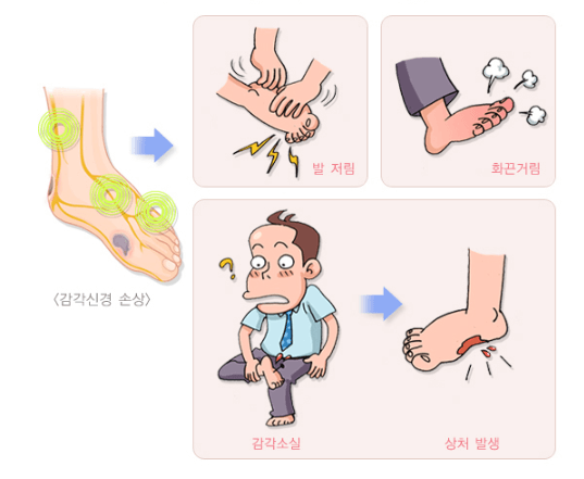 당뇨발증상