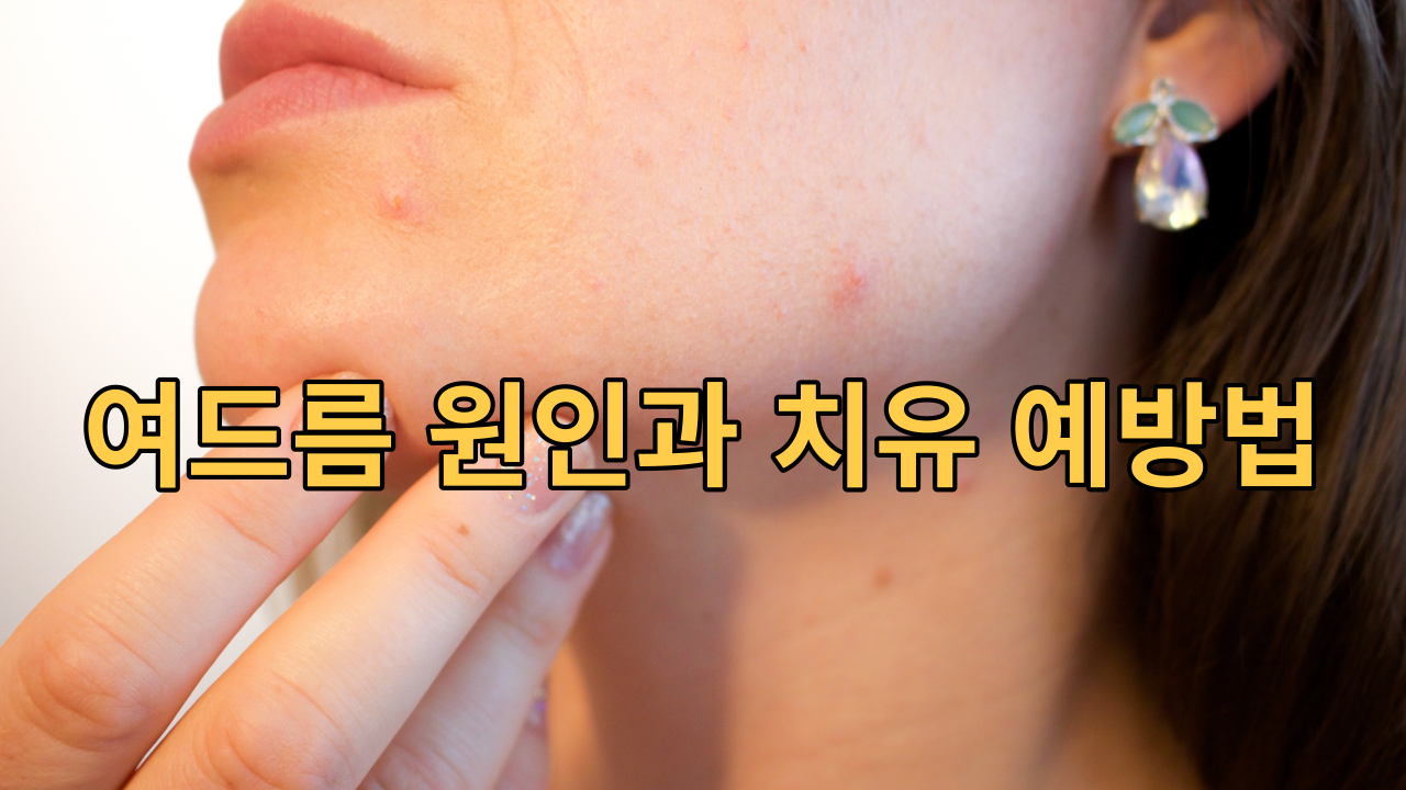  여드름 원인과 치유 예방법