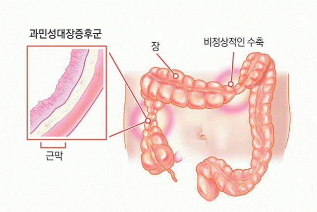 과민성 대장증후군 증상. 치료