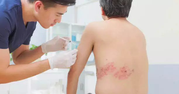 대상포진 초기증상 치료방법