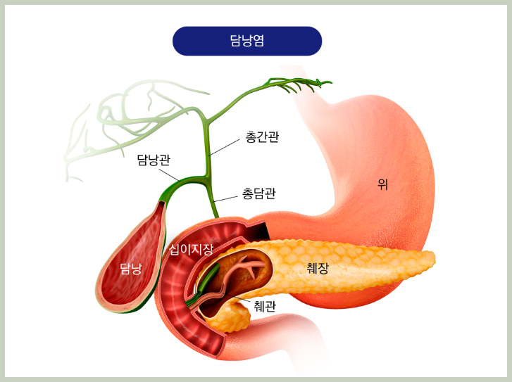 담낭염