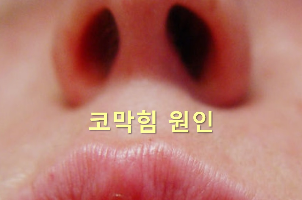  코막힘 원인과 코막힘 한번에 해결 방법