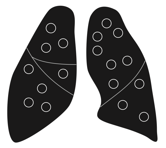 cystic lung lesion 모식도