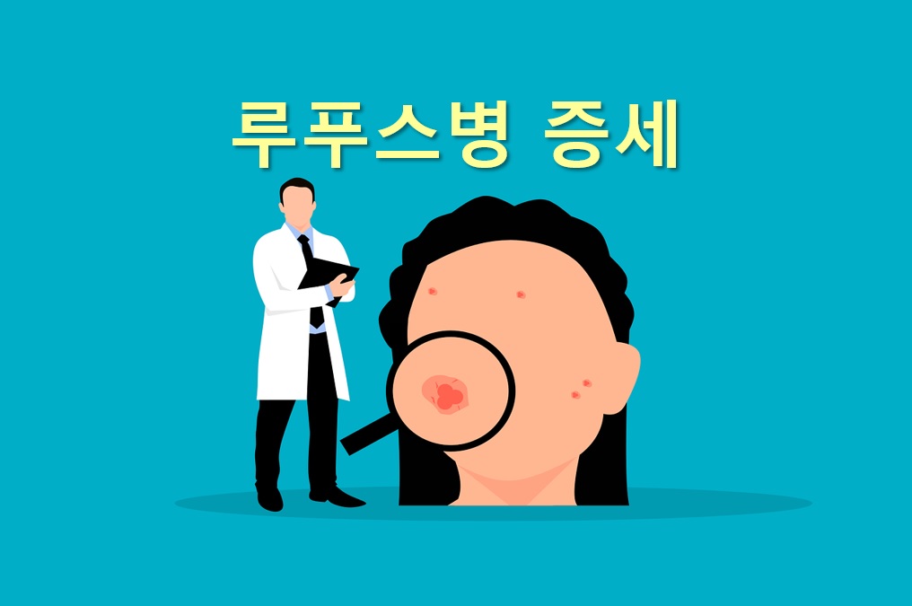  루푸스병 증세와 루프스병 치료 방법