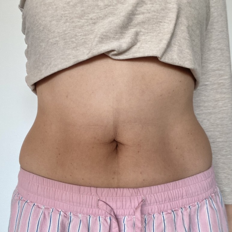 한달째 배살빼는법 실행결과 복부지방분해주사 - 12