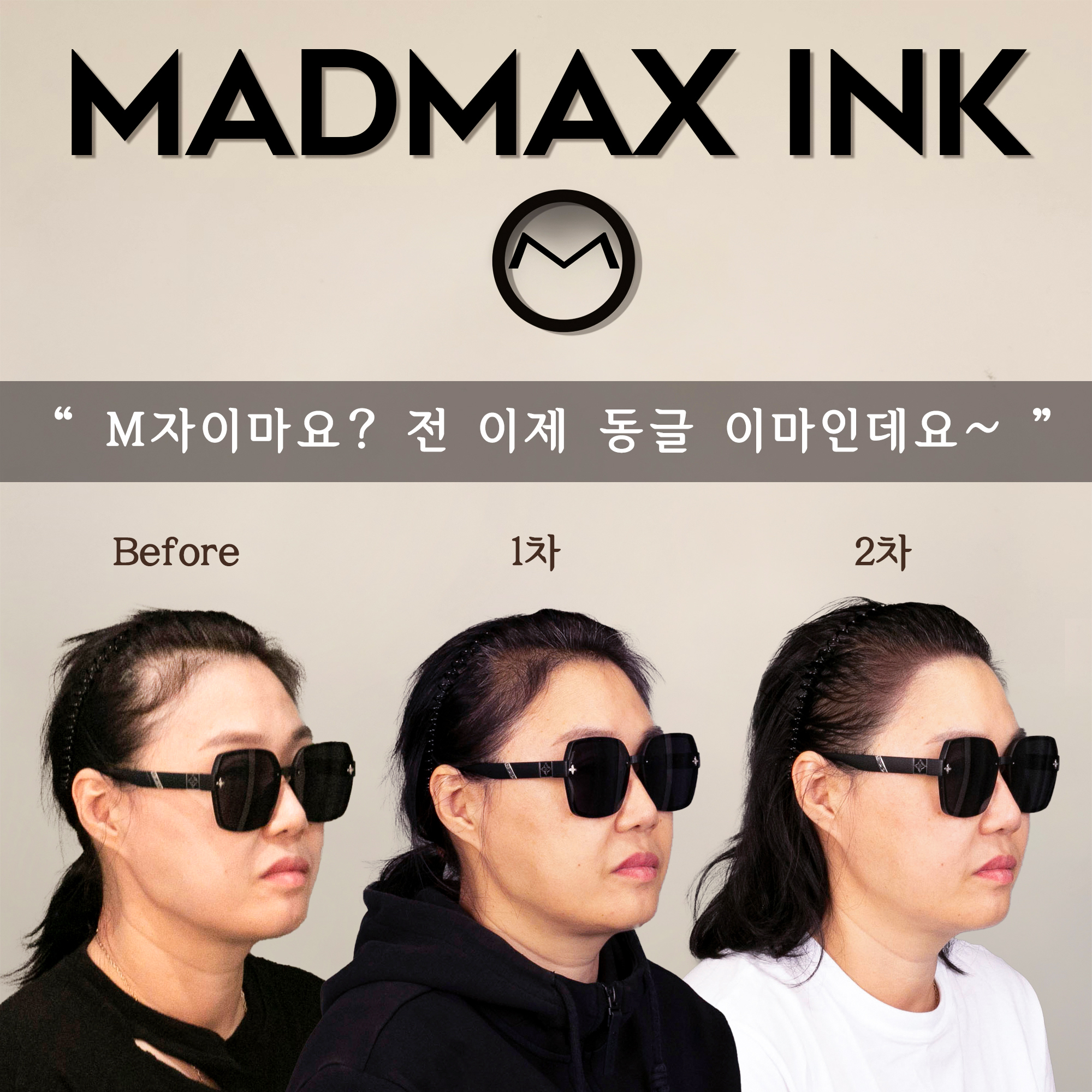 헤어라인 이미지