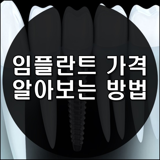  임플란트 가격 알아보는 방법