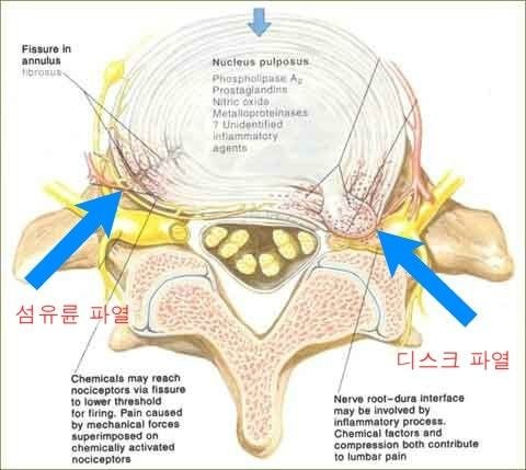  윗몸일으키기 운동을 하지 말라고 하는 이유