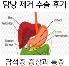 담낭-제거-수술-후기