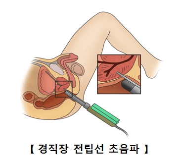 전립선 증상&#44;진단&#44;수술&#44;영양제&#44;예방