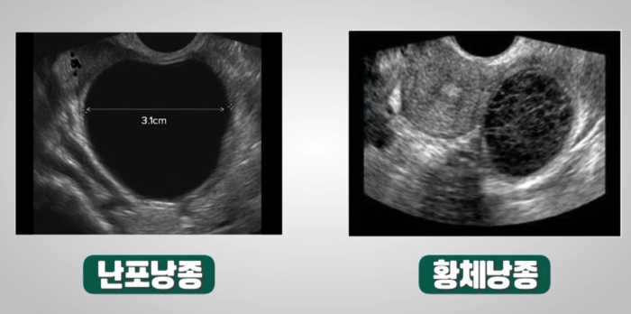 자궁-난소낭종-물혹
