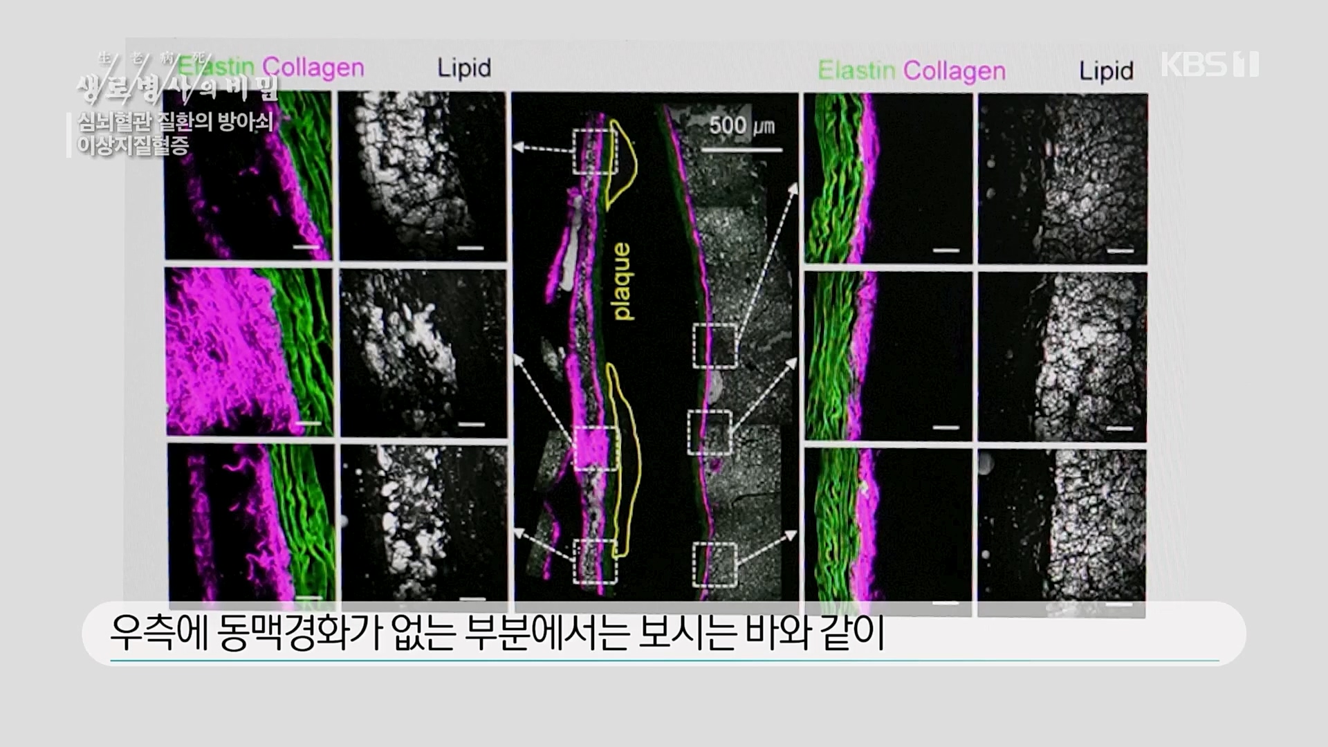 생로병사의 비밀.E862.230329p.H264-F1RST.mp4_20230330_203225.102.jpg