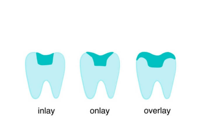 치과치료-인레이-온레이-비교