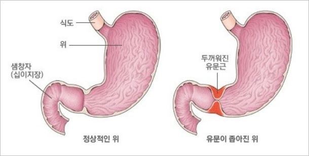 유문협착증-위와-십이지장-근육두꺼워진-사진