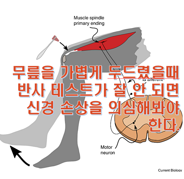 허리디스크 터지면 나타나는 증상과 실용적인 치료 전략들