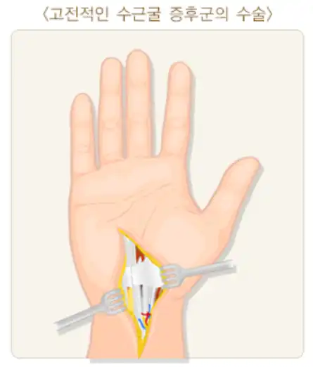 손목터널증후군-고전수술-이미지