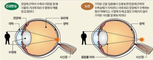 건강한눈-노안눈-비교