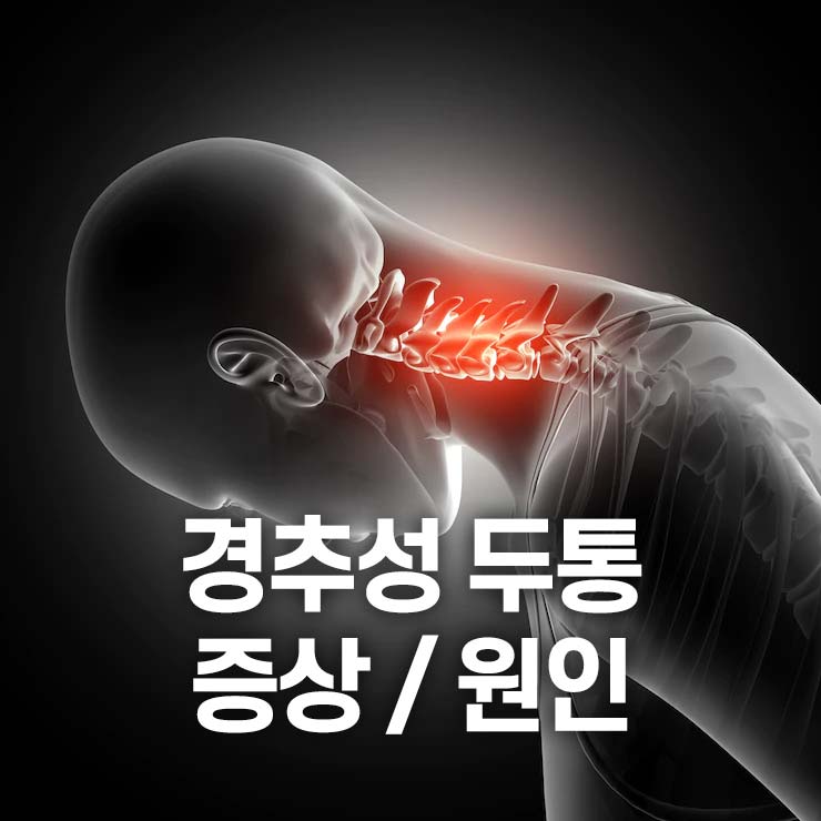 경추성 두통