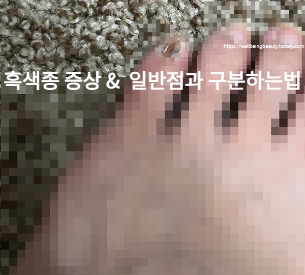  흑생종 초기증상 새끼발가락 손발톱  일반점과 흑색종 구분하는법  원인치료법 피부암 흑색종Melanoma병원 조직검사 ㅣ 자외선차단제고르는법추천