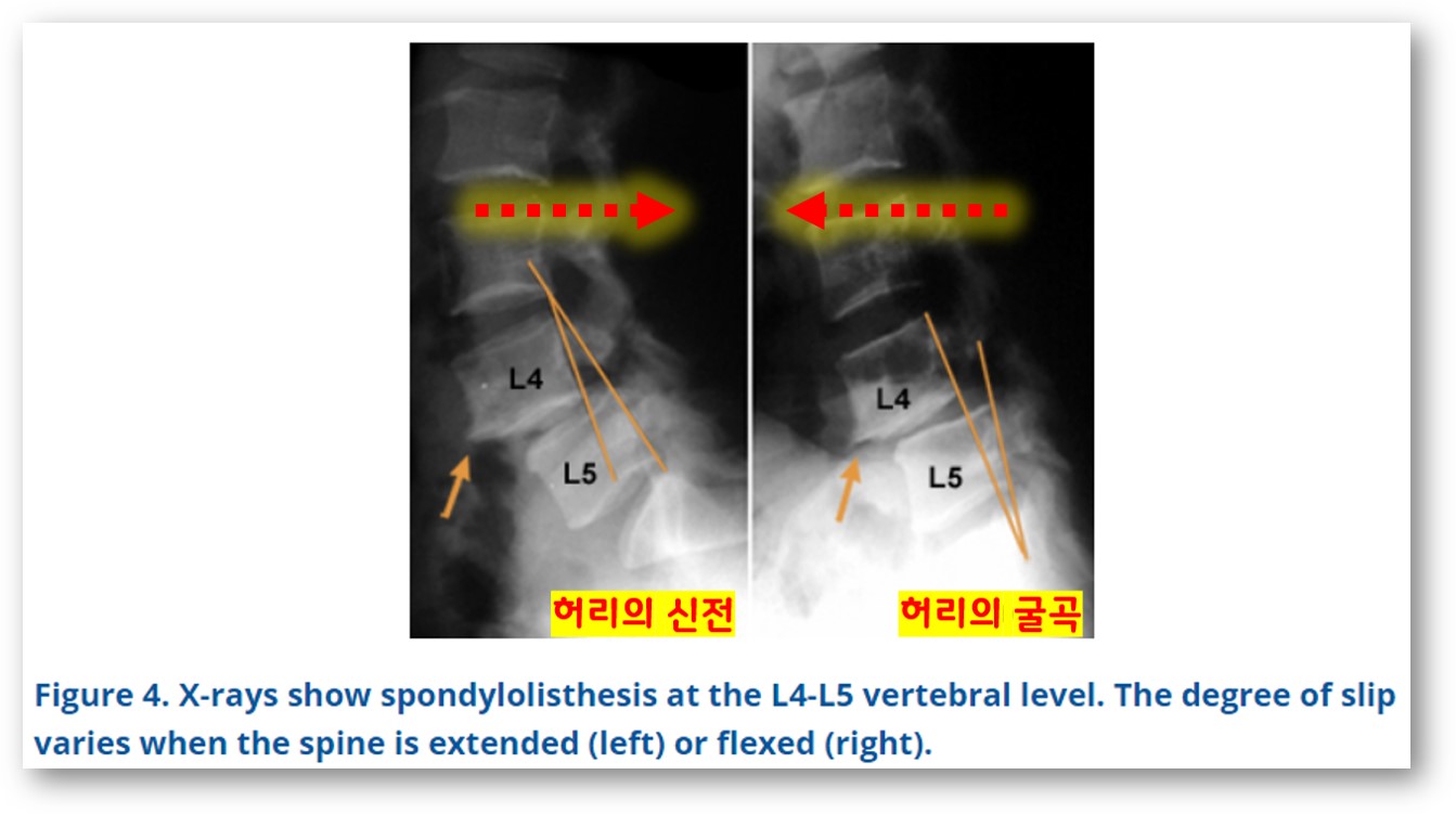 척추 전방전위증 허리의 굴곡과 신전시 X-ray 비교