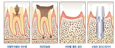 치아 우식증2