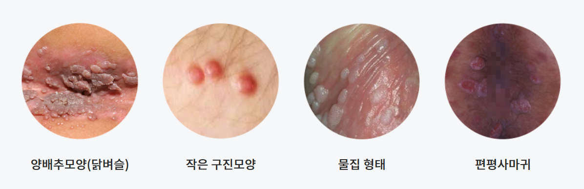 곤지름, 콘딜로마