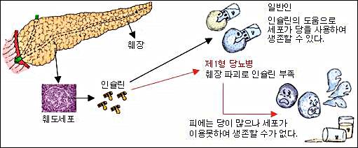  코로나 사태에 집에서 당뇨병 관리하는 방법