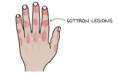 Gottron lesions