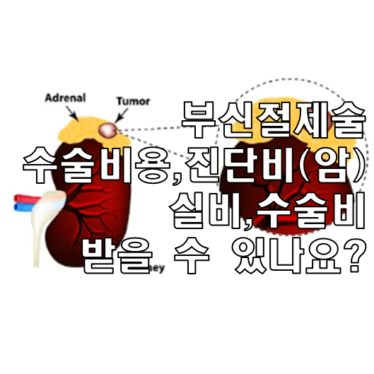 부신종양 절제술 썸네일