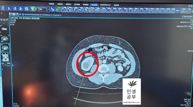 37세 남 신장 물혹 CT사진