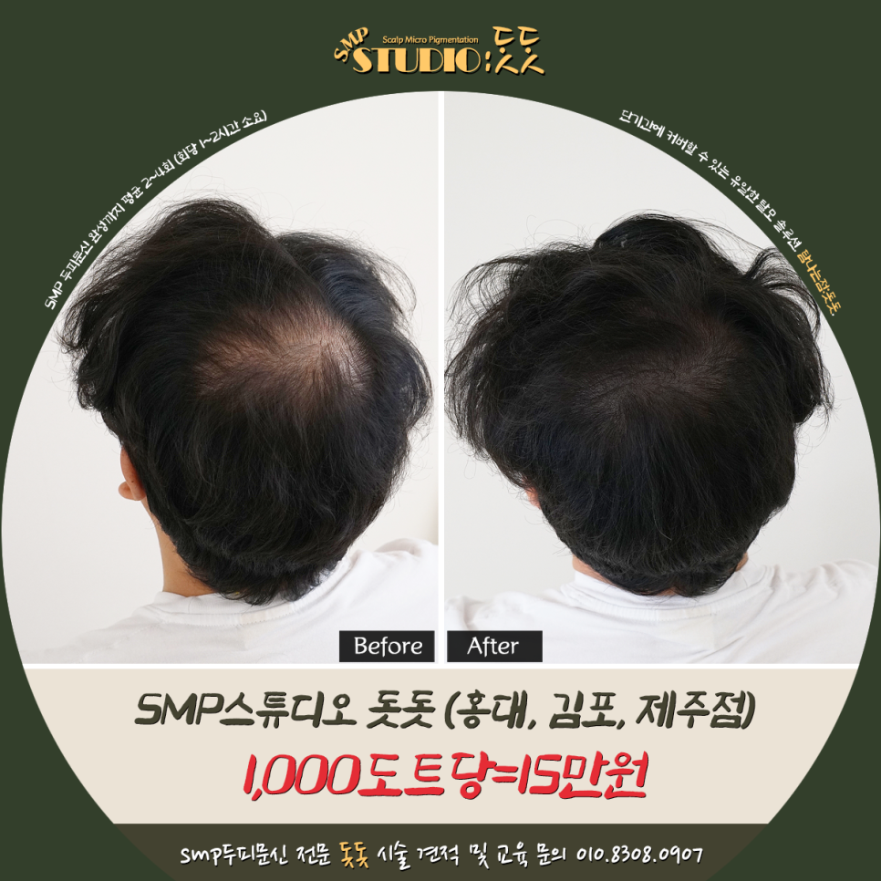  두피문신 후기로 알아보는 실제 커버 효과?