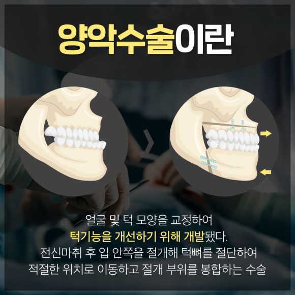  " 양악수술 : 알고 하지 않으면 돌이킬 수 없습니다."