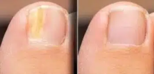  발톱 무좀 증상, 발톱 무좀약 종류