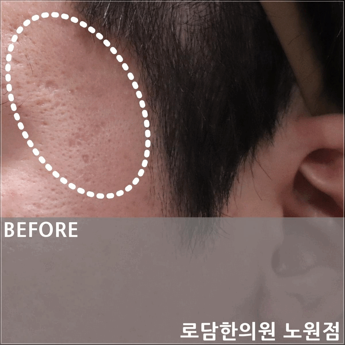  남양주 여드름 흉터 패인 자국 새살침 치료 과정